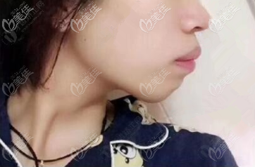 術前我嘴凸 術前我嘴凸