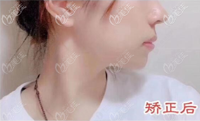 這是我戴時代天使矯正牙齒內(nèi)收4mm效果圖，本人骨性牙性混合齙牙