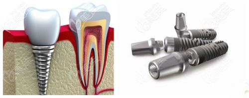 鈦合金種植體 鈦合金種植體