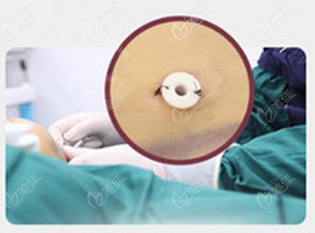 常州博仕做大腿吸脂的優(yōu)勢