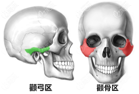 顴骨手術(shù)圖示