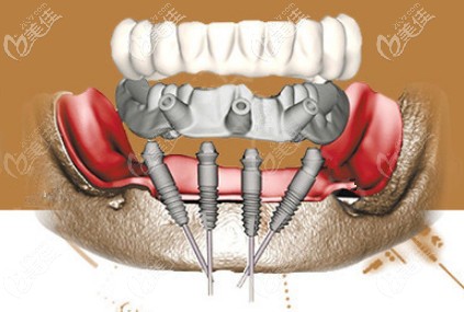 溫長興醫(yī)生做韓系種植牙過程