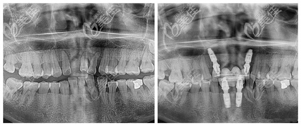 藍天口腔醫(yī)生溫長興做種植牙實例