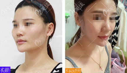 顴骨內(nèi)推術(shù)后效果圖