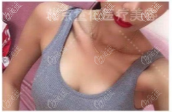 趙翊利傲諾拉閃耀毛面圓形假體隆胸案例 趙翊利傲諾拉閃耀毛面圓形假體隆胸案例