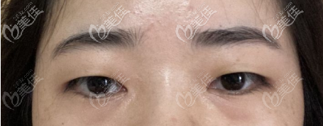 術(shù)前的眼部情況 術(shù)前的眼部情況