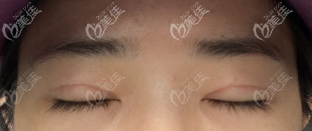 閉眼時候的6.5毫米寬度 閉眼時候的6.5毫米寬度