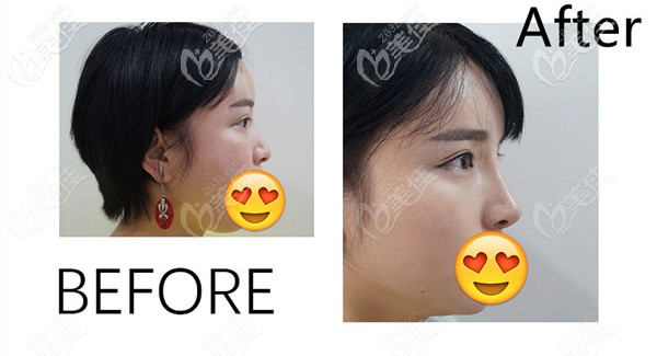 王院長做隆胸的效果展示