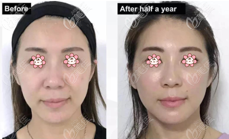 藍(lán)鉆魚骨線全臉提升案例圖