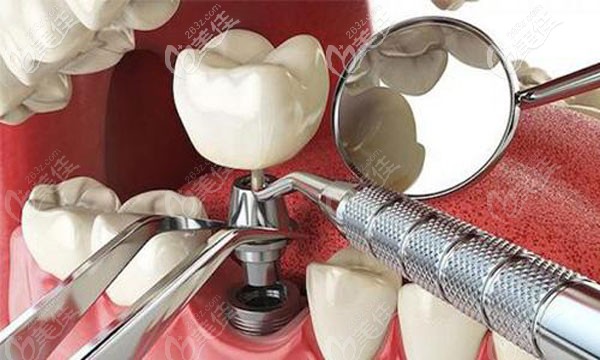 洋紫荊口腔微創(chuàng)種植牙技術(shù)優(yōu)勢