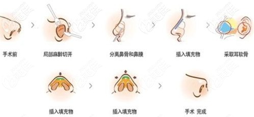 連桂賓醫(yī)生做耳軟骨隆鼻過程