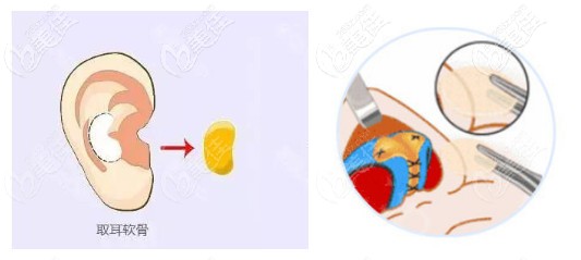寧波壹加壹林勇醫(yī)生做耳軟骨鼻綜特色