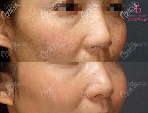 在信陽正規(guī)整形醫(yī)院做了1次755蜂巢皮秒激光去斑,斑點沒了也沒花多錢