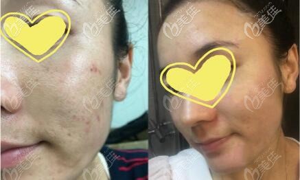 脈沖光法痘印真實(shí)治療效果圖 脈沖光法痘印真實(shí)治療效果圖