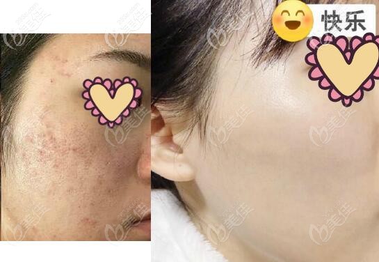 強(qiáng)脈沖光祛痘印真實(shí)治療效果對(duì)比圖 強(qiáng)脈沖光祛痘印真實(shí)治療效果對(duì)比圖