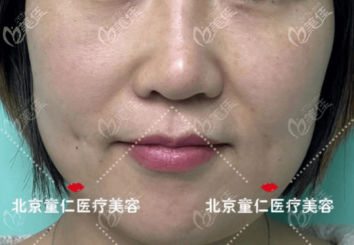 找趙翊利醫(yī)生做SAC鼻基底抬高術(shù)前 找趙翊利醫(yī)生做SAC鼻基底抬高術(shù)前