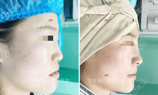 鼻基底抬高術(shù)前后即刻對比效果圖 鼻基底抬高術(shù)前后即刻對比效果圖