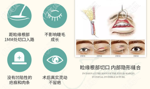 朱建瑩醫(yī)生做眼部整形手術(shù)的優(yōu)勢