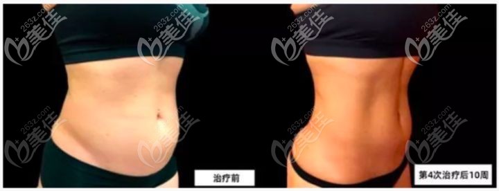 做BTL脂肪刀四次的瘦身效果
