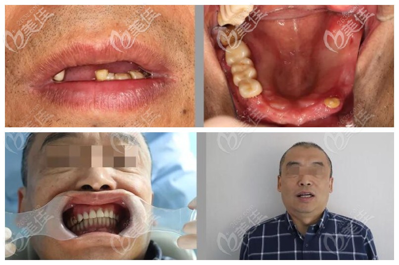 我1年前在柯橋牙科醫(yī)院做的下半口即刻負(fù)重種植牙挺靠譜的，價(jià)格挺實(shí)惠還沒有后遺癥