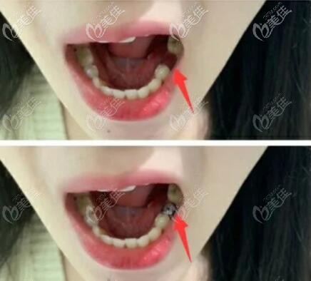 美國百康種植牙案例效果