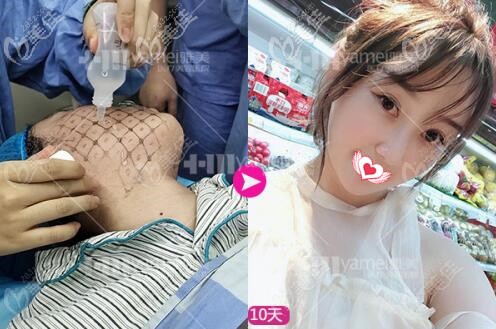 熱瑪吉治療過程與術(shù)后10天效果照