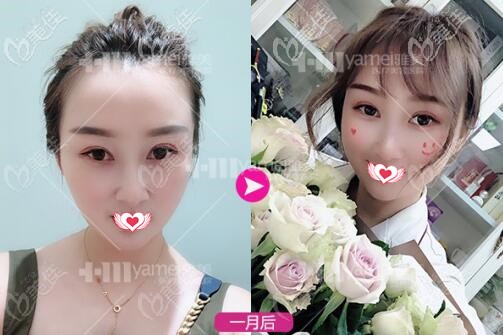 做熱瑪吉全臉1個(gè)月時(shí)的效果照