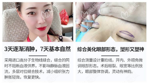 深圳藝星整形黃海俠醫(yī)生雙眼皮優(yōu)勢(shì) 深圳藝星整形黃海俠醫(yī)生雙眼皮優(yōu)勢(shì)