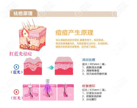 紅藍光治療痘痘的原理