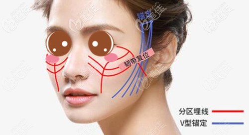 韓勝醫(yī)生做面部埋線提升的優(yōu)勢