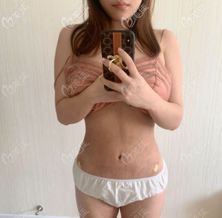 我做完腰部吸脂后使胯骨變窄了，一個月的效果圖奉上供參考