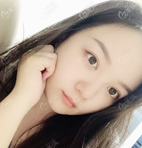 廣州張克醫(yī)生雙眼皮做的好自然價(jià)格也不貴哦