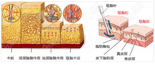 廣州壹加壹黃文誼醫(yī)生吸脂優(yōu)勢