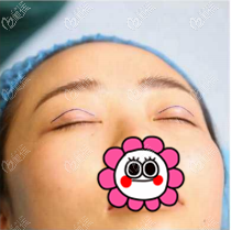 做手術(shù)當(dāng)天 做手術(shù)當(dāng)天