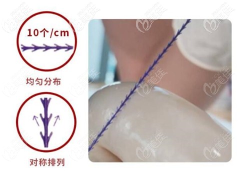 藍(lán)鉆魚(yú)骨線的優(yōu)勢(shì)