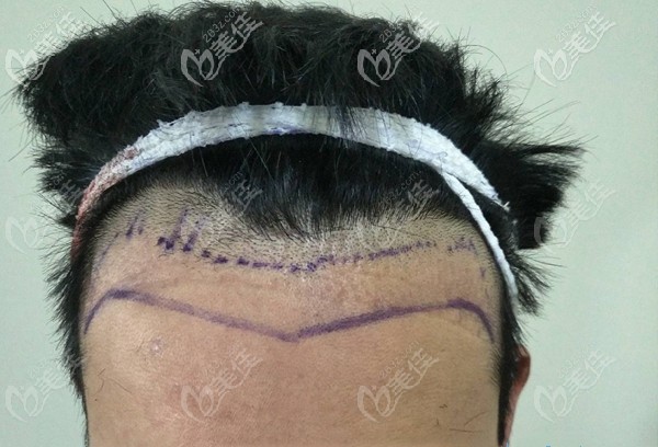 男士發(fā)際線種植術前照 男士發(fā)際線種植術前照