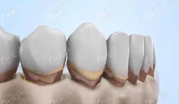 牙槽骨出現(xiàn)不同程度的萎縮