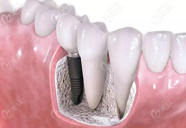 韓國奧齒泰種植體優(yōu)勢