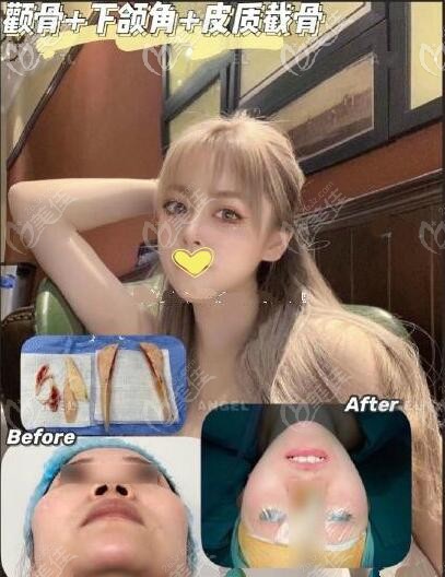 韓國(guó)醫(yī)生吉玟錫磨骨案例效果對(duì)比圖 韓國(guó)醫(yī)生吉玟錫磨骨案例效果對(duì)比圖