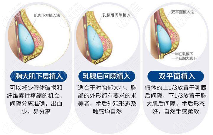 湛江澳泰整形醫(yī)院隆胸植入層次<span style= 湛江澳泰整形醫(yī)院隆胸植入層次<span style=