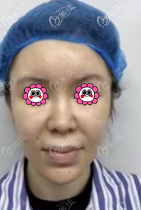 做SAMS筋膜面部提升前 做SAMS筋膜面部提升前