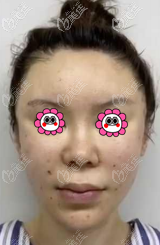 在北京童仁做完SAMS筋膜面部提升手術(shù)到現(xiàn)在,真沒(méi)發(fā)現(xiàn)有啥危害