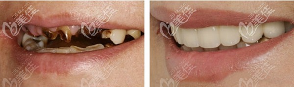 福州貝臣口腔登騰Allon4半口種植牙效果真不錯(cuò)，果然專業(yè)醫(yī)生和儀器少不了