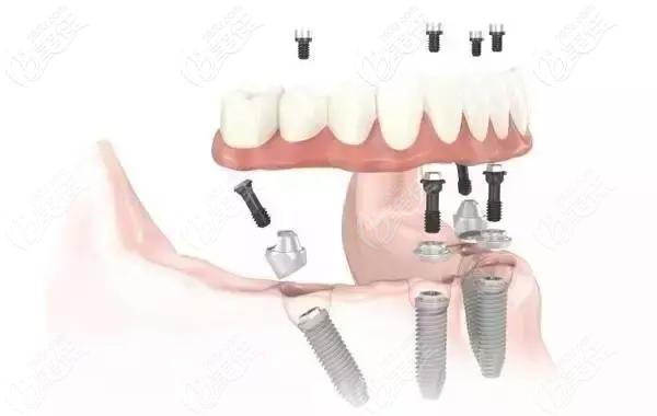 福州貝臣口腔登騰Allon4種植牙技術(shù) 福州貝臣口腔登騰Allon4種植牙技術(shù)