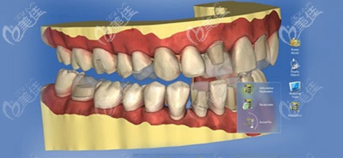 福州貝臣3D手術(shù)導(dǎo)板技術(shù) 福州貝臣3D手術(shù)導(dǎo)板技術(shù)