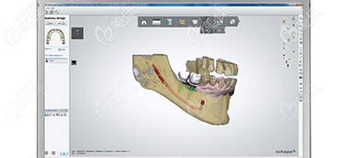福州貝臣AD / CAM方案設(shè)計 福州貝臣AD / CAM方案設(shè)計