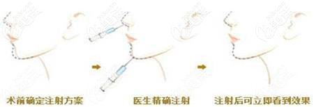 伊婉玻尿酸v型適合打下巴和鼻子 伊婉玻尿酸v型適合打下巴和鼻子