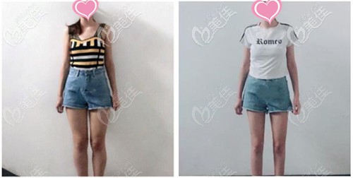 青島諾德何瑞蛟吸脂案例