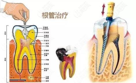 根管治療 根管治療