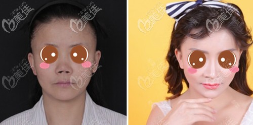 北京劉彥軍鼻修復(fù)案例